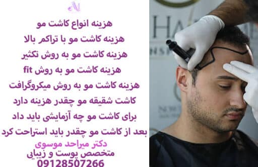 هزینه کاشت مو با تراکم بالا