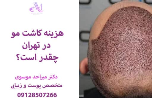 هزینه کاشت مو در تهران
