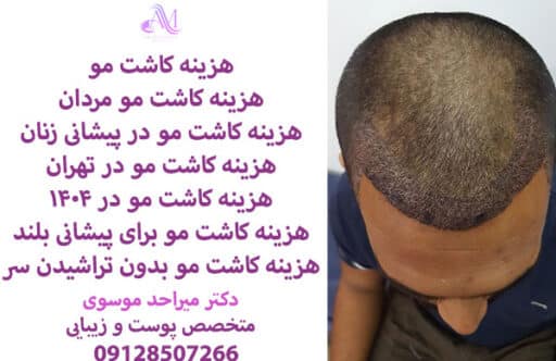 هزینه کاشت مو مردان