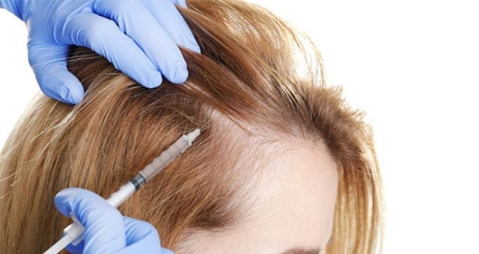 چه کسانی می توانند از روش درمانی مزوتراپی مو استفاده کنند؟