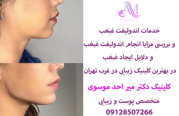 دلایل ایجاد غبغب