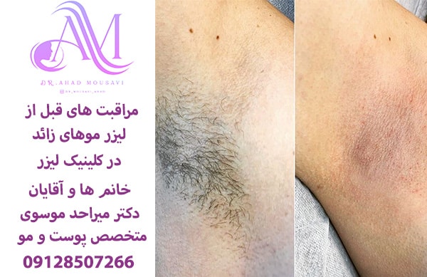 مراقبت های قبل از لیزر موهای زائد بدن و صورت و بیکینی