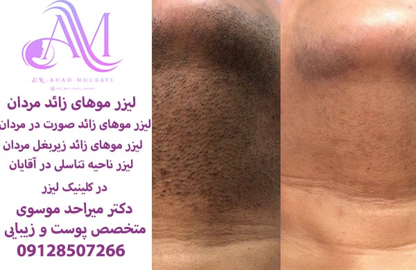 لیزر موهای زائد مردان با دستگاه الکساندرایت