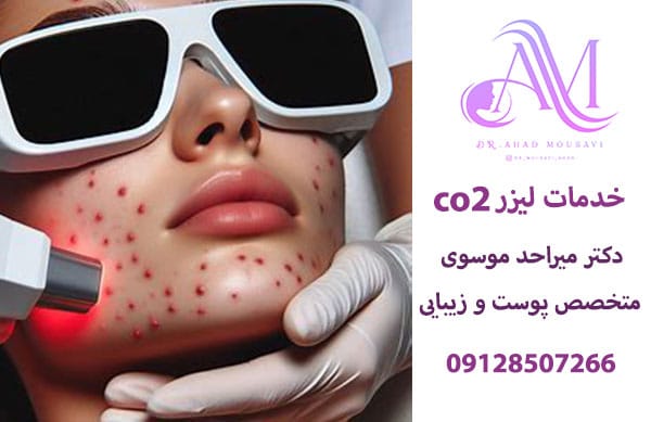 درمان جای جوش با لیزر co2 فرکشنال در تهران