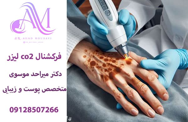 خدمات لیزر co2 فرکشنال در تهران و درمان جای سوختگی و اسکار