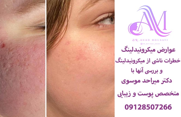 عوارض میکرونیدلینگ