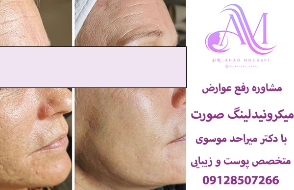 مشاوره رفع عوارض میکرونیدلینگ صورت و جای جوش