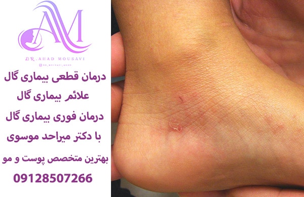 درمان قطعی گال و درمان فوری گال