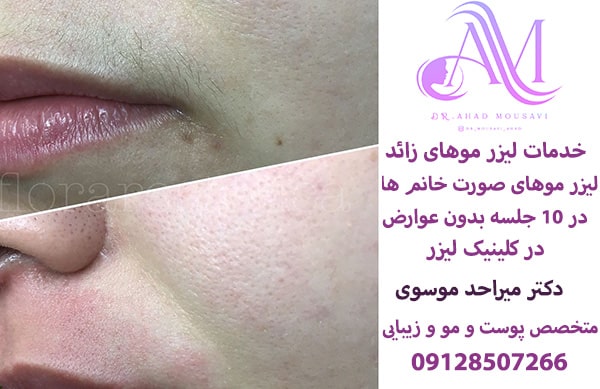 خدمات لیزر موهای زائد صورت و بدن