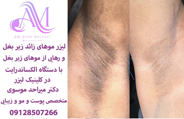 لیزر موهای زائد زیر بغل