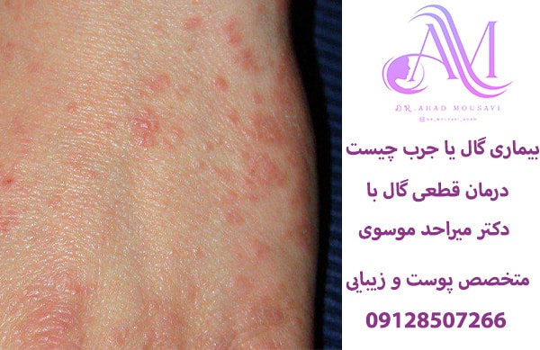 بیماری گال یا جرب چیست