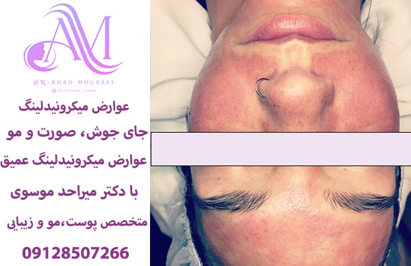 عوارض میکرونیدلینگ جای جوش