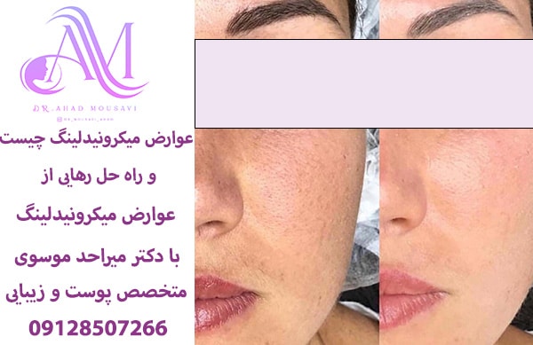 عوارض میکرونیدلینگ چیست