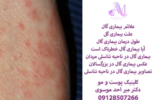 علائم بیماری گال