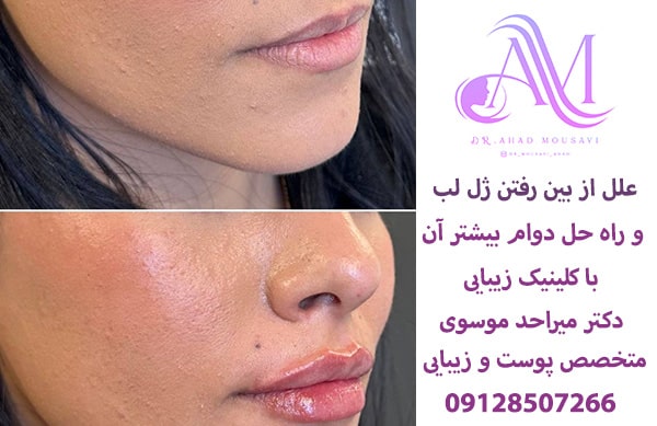 علل از بین رفتن ژل لب