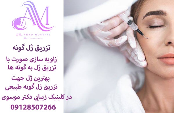 تزریق ژل گونه