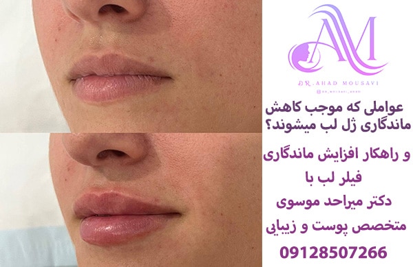 عواملی که موجب کاهش دوام ژل لب می‌شود