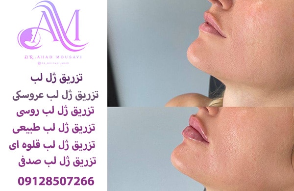 تزریق ژل لب