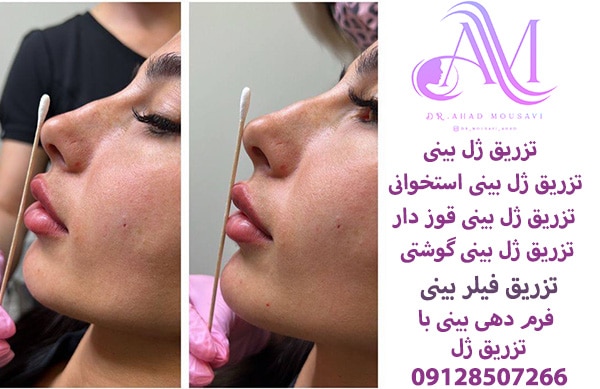 تزریق ژل بینی