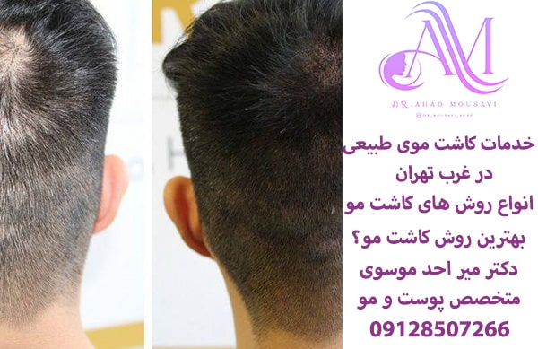 خدمات کاشت موی طبیعی در غرب تهران