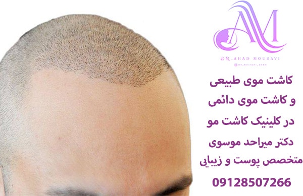 کاشت موی طبیعی و دائمی