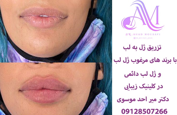 تزریق ژل به لب کاملا دائمی