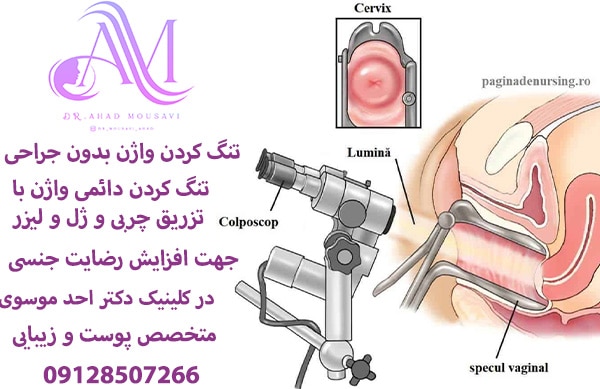 تنگ کردن واژن بدون جراحی