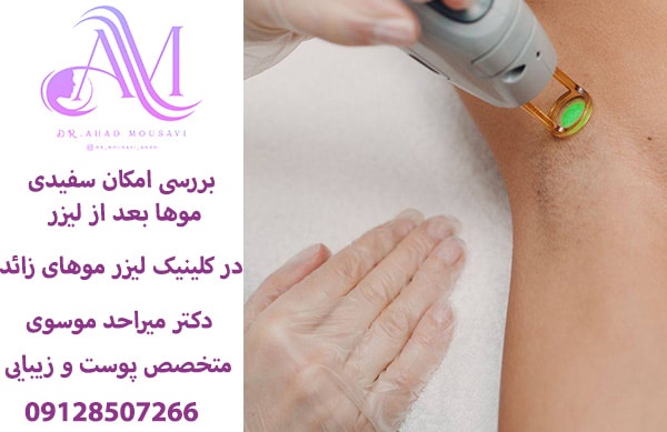 بررسی امکان سفیدی موها بعد از لیزر موهای زائد