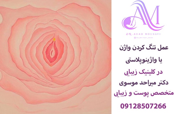 عمل تنگ کردن واژن