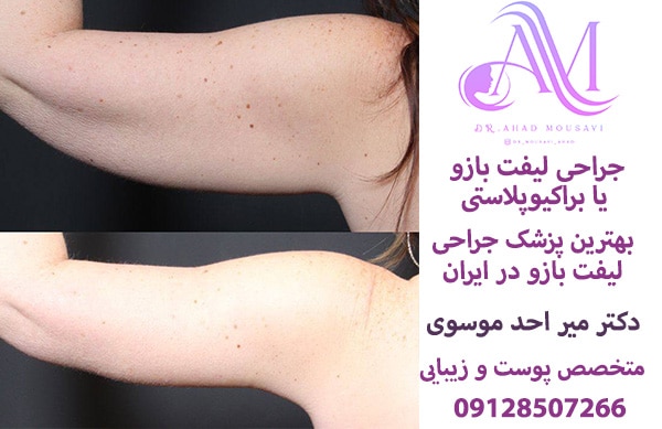 جراحی لیفت بازو یا براکیوپلاستی