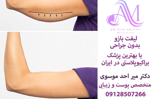 لیفت بازوها بدون جراحی