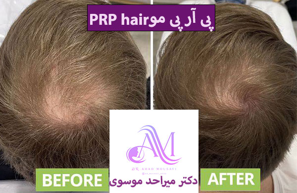 پی آر پی مو (PRP hair)
