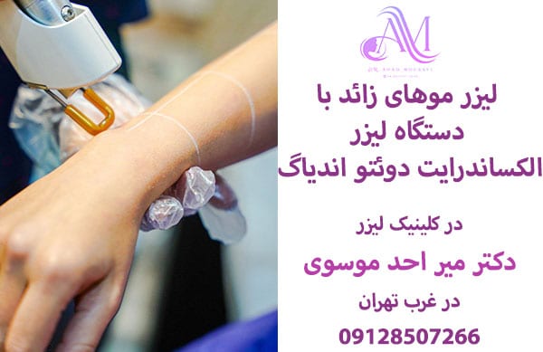 لیزر موهای زائد با دستگاه الکساندرایت دوئتو ان دیاگ