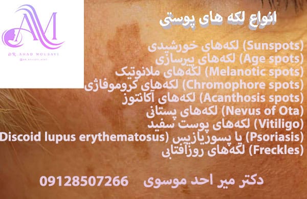 انواع لکه های پوستی