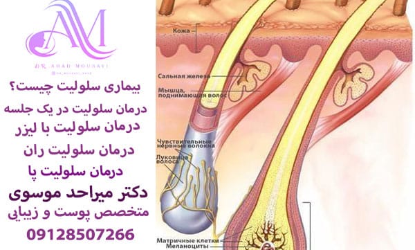 بیماری سلولیت چیست