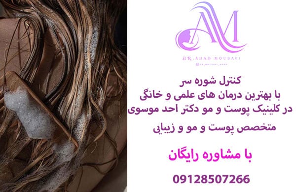 کنترل شوره سر