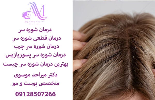 درمان شوره سر