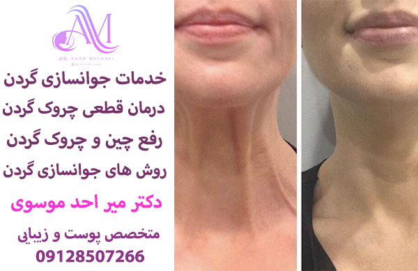 خدمات جوانسازی گردن