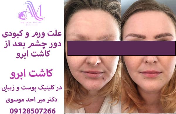 علت ورم و کبودی دور چشم بعد از کاشت ابرو
