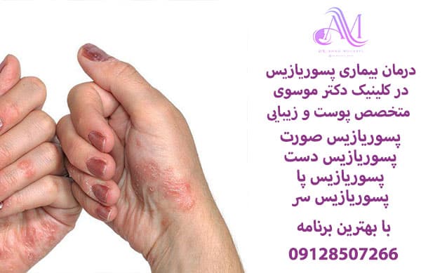 پسوریازیس صورت