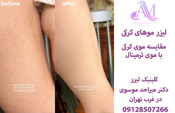 لیزر موهای کرکی و نازک