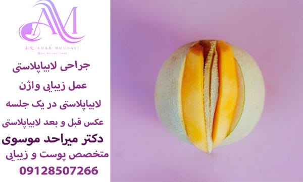 جراحی لابیاپلاستی