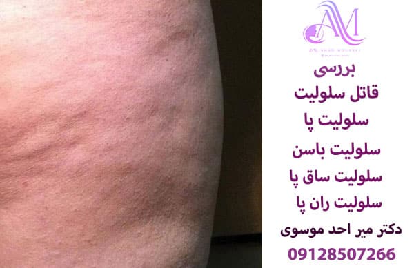 سلولیت پا