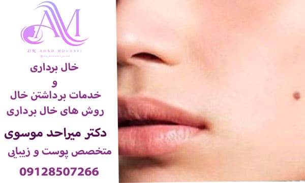 برداشتن خال