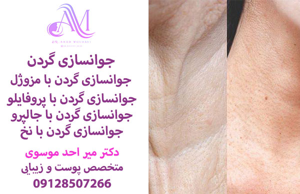 جوانسازی گزدن با مزوژل