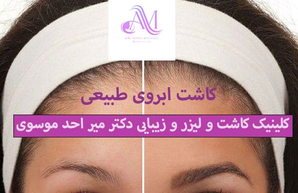 روش رفع ورم دور چشم