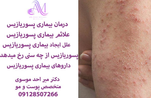 درمان بیماری پسوریازیس