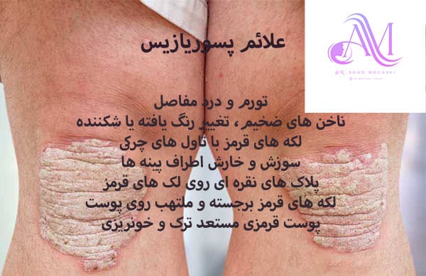 آیا پسوریازیس باعث چاق شدن میشود؟