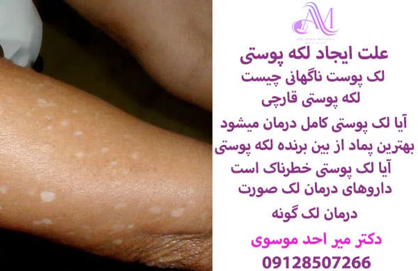 علت ایجاد لکه پوستی