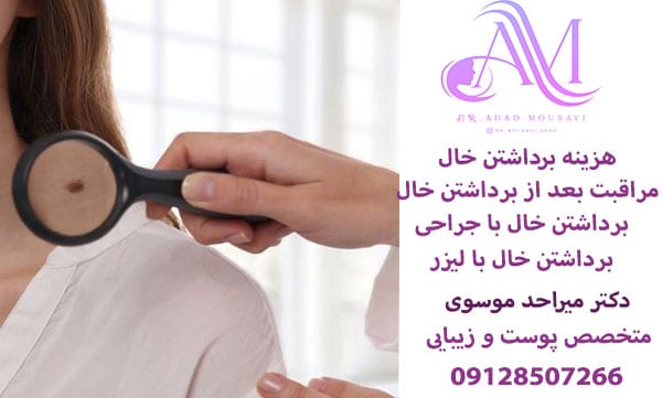 هزینه برداشتن خال